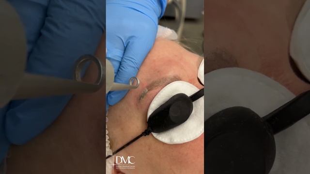 Процедура лазерного удаления татуажа бровей в процессе. Как проводится удаление старого татуажа. смотреть онлайн