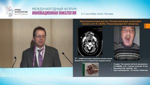 Традиционные хирургические доступы для лечения рака ротоглотки. Карпенко А.В.