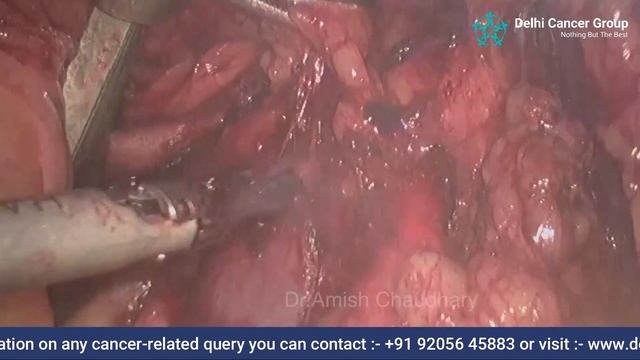 Laparoscopic Para Aortic Lymph Node Dissection in CA Endometrium смотреть онлайн