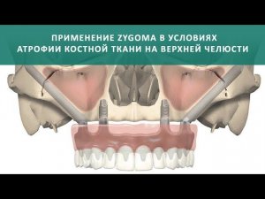 Скуловая имплантация Зигома (Nobel Zygoma)