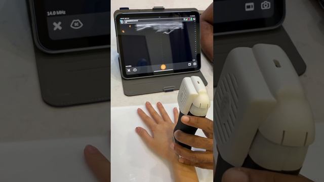 Portable #ultrasound: Clarius - Scanning the Wrist (Part 1)