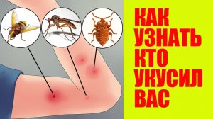 Укусы Насекомых. Как отличить Что Делать. Как Вытащить Клеща