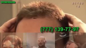 система замещения волос. "Astra Enterprise"