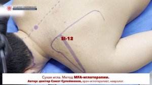 Сухая игла. Supraspinatus. НАДОСТНАЯ МЫШЦА. Безопасная постановка иглы.
