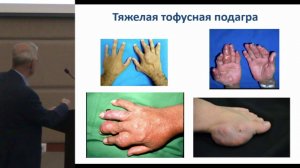 Варданян А.В. Лечение подагры: взгляд хирурга | Подагра | Ревматология | Острый подагрический артрит