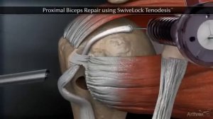 Тенодез сухожилия длинной головки бицепса (Proximal Biceps Repair using SwiveLock Tenodesis)