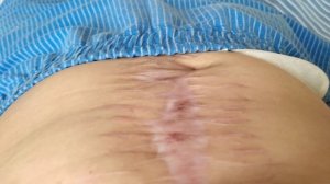 В госпитале жду операции.