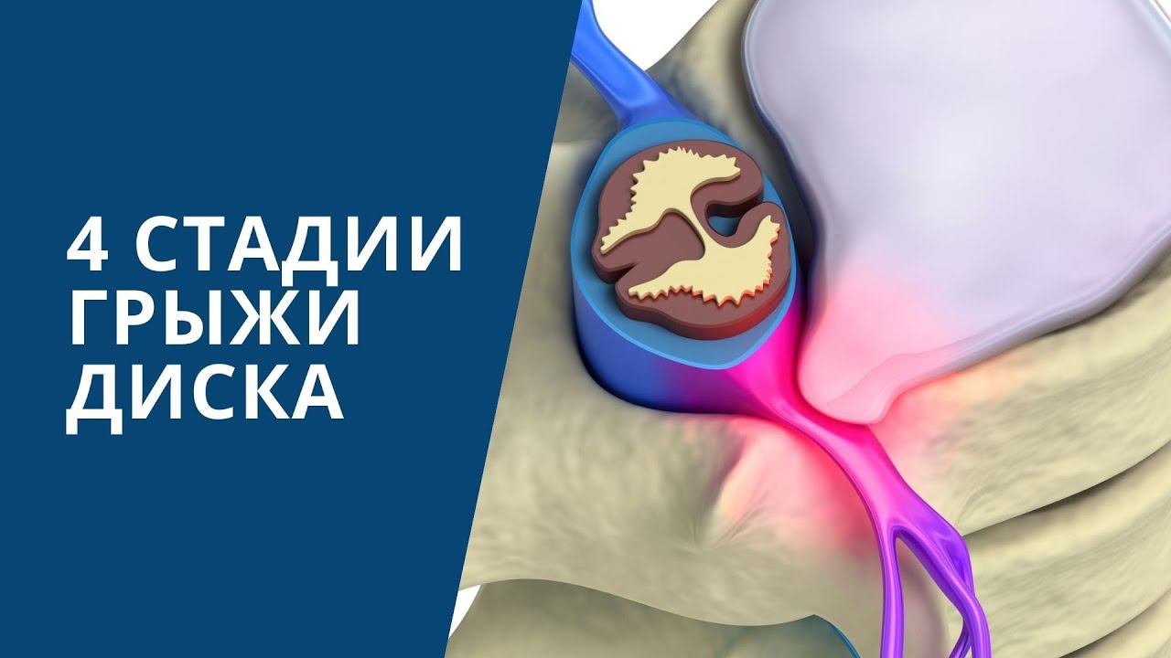 Какие симптомы бывают на разных стадиях грыжи диска