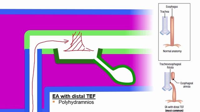 USMLE RX - 4.Желудочно-кишечный тракт - 2.Эмбриология - 5.Трахеоэзофагеальные аномалии