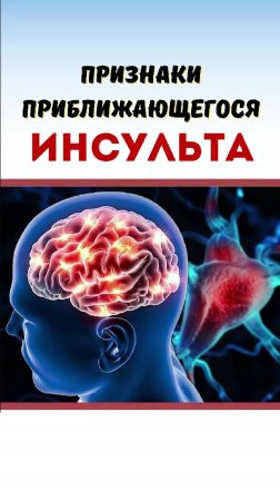 Симптомы предвестники инсульта