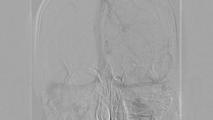 Селективная церебральная ангиография при атериовенозной мальформации