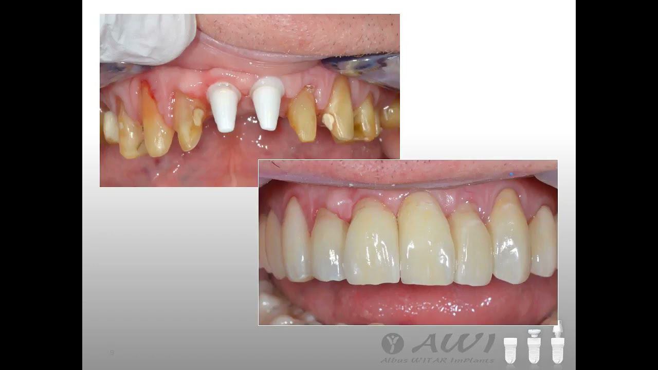 Клинический случай 4 с применением циркониевых имплантатов Albus WITAR Implants (AWI)