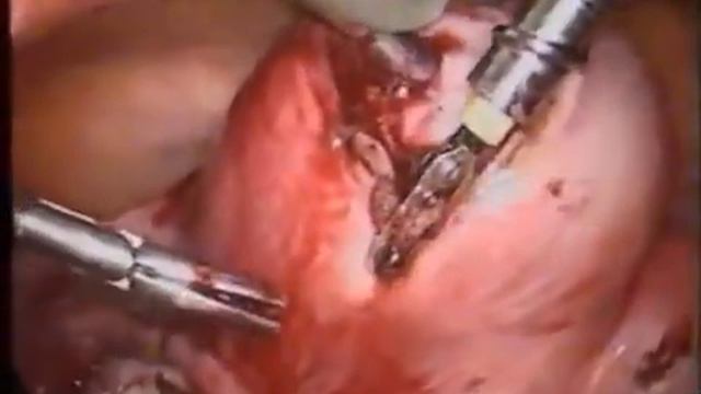 Лапароскопическая миомэктомия. Laparoscopic Myomectomy смотреть онлайн