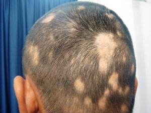 Очаговая алопеция: причины.
