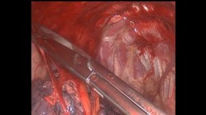 Удаление булл легкого и плеврэктомия. ПацГ0517.