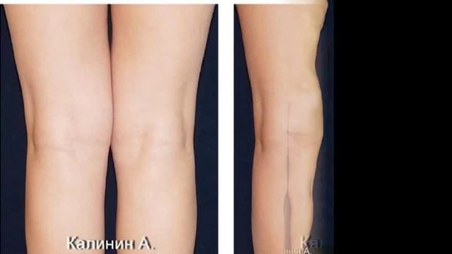 РУЧНАЯ ЛИПОКОРРЕКЦИЯ ФИГУРЫ