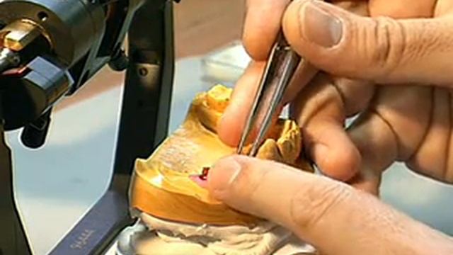 Изготовление мостовидного протеза на 2 имплантах смотреть онлайн