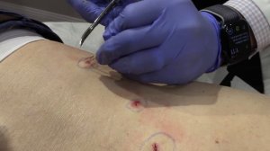 Black INK Steatocystoma!!! | Dr. Derm