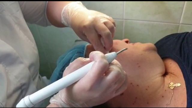 Удаление родинок на лице