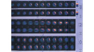 Anterior and inferior wall infarct on 99mTc myocardial perfusion imaging