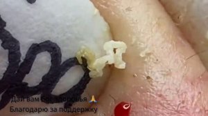 ЧЕРНЫЕ ТОЧКИ? ВЫДАВЛИВАНИЕ. УХОД ЗА ЛИЦОМ
