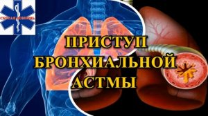 Приступ бронхиальной астмы