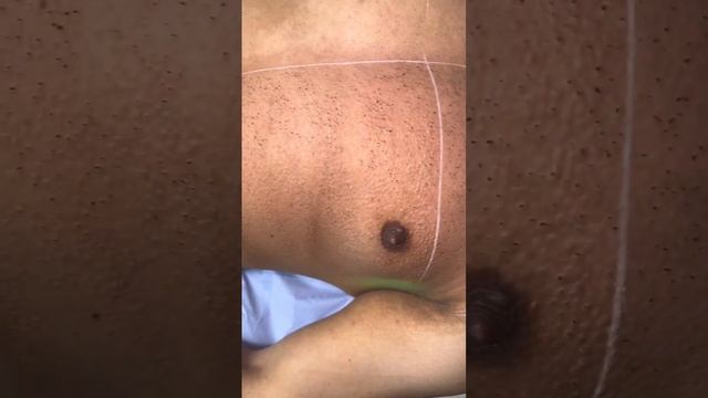 Before & after laser hair removal ⚡️ смотреть онлайн