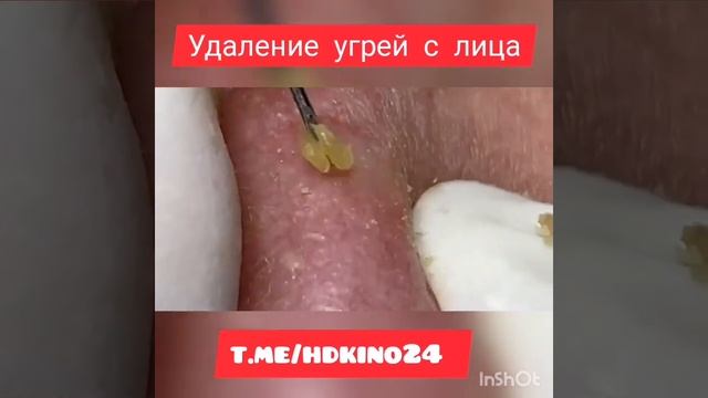 Выдавливание чёрных точек угрей и прищей на лице новое