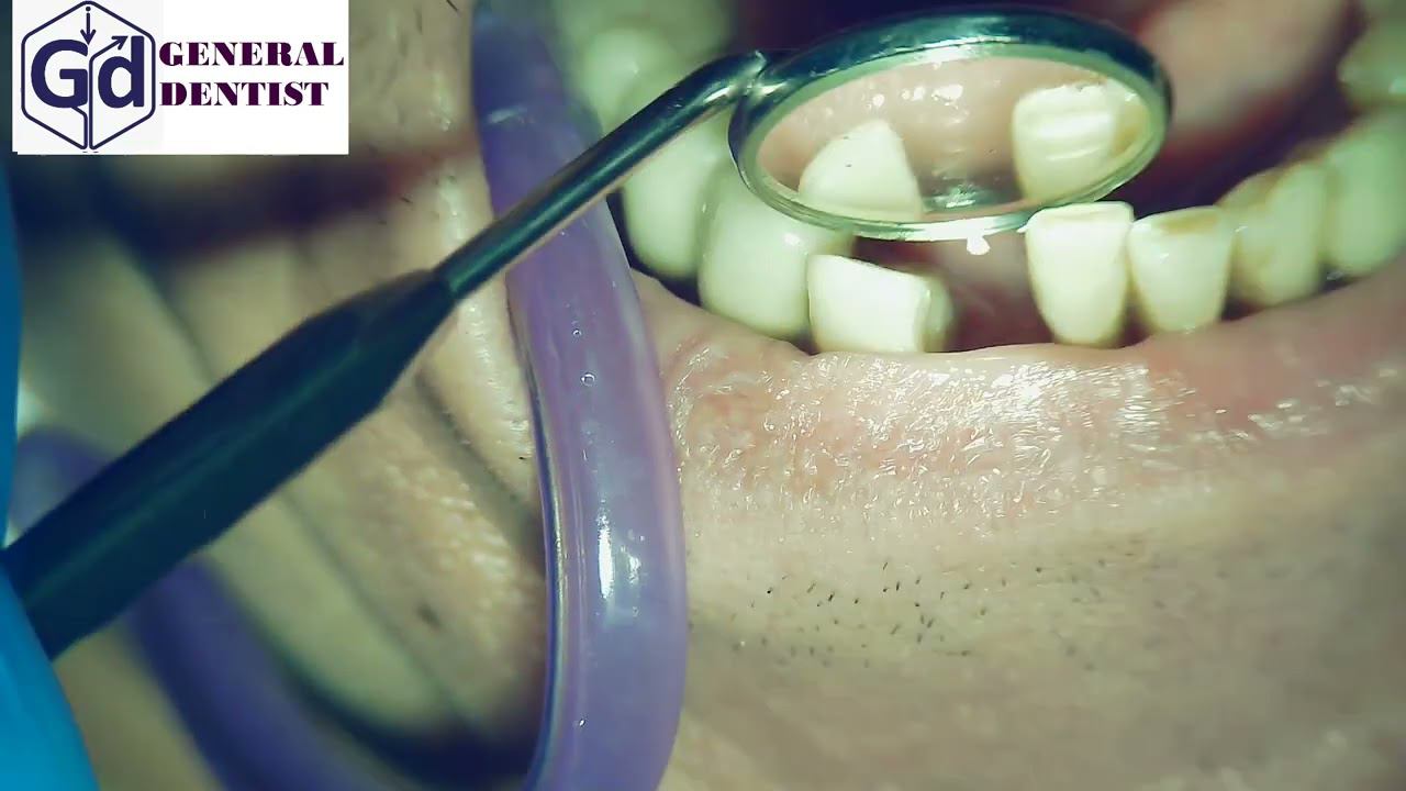 Infiltration anesthesia for insertion gingiva former 42.