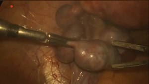 2ст гидросальпинкс. тубэктомия