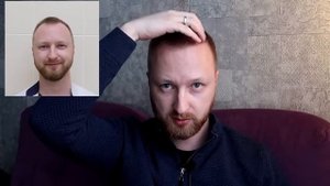 3 месяца после пересадки волос, Стамбул , Turkey Hair Academy
