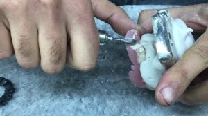 Перебазировка зубного протеза | Denture rebase