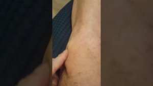 Коленный сустав после артроскопии. Уплотнения (шишки) под швами.