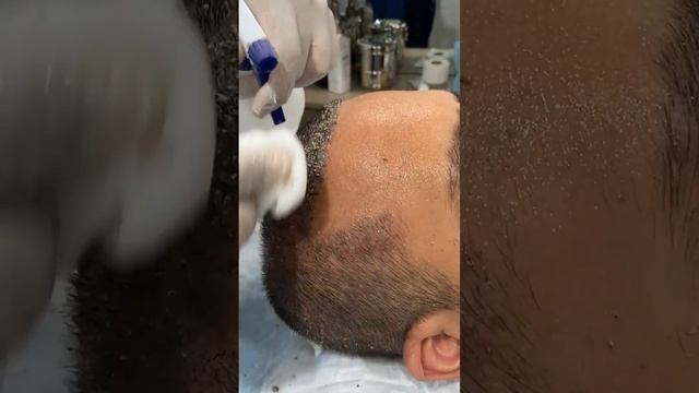 Head Wash After Hair Transplant | 1st Head Wash | Scabs Removal