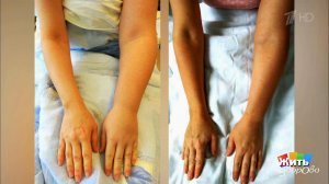 Лимфедема. Новейшая технология лечения слоновости. Жить здорово! Фрагмент выпуска от 04.12.2019