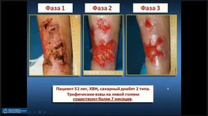 Венозные трофические язвы нижних конечностей