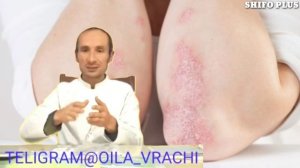 ПСОРИАЗ КАСАЛЛИГИ ХАКИДА ФОЙДАЛИ ТАФСИЯЛАР PSORIAZ KASALLIGI