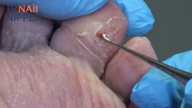 What is under the Callus?  [Callus Tuesday] (2020) смотреть онлайн