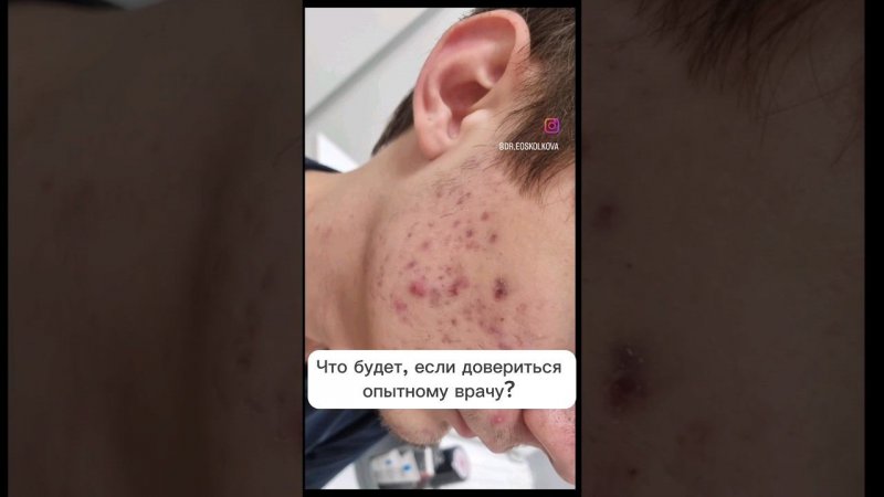 а вы доверяете своему врачу? #будниврача #дерматолог #лечениеакне #акне #прыщи #прыщиналице #врач