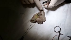 Ушивания продольная рана кишечника