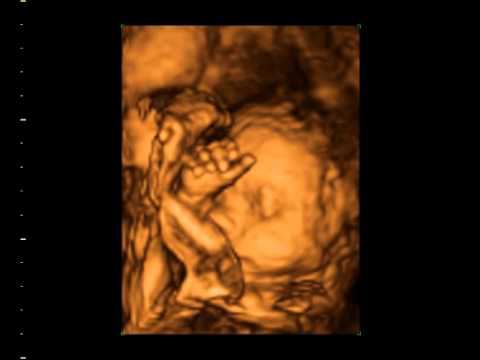3D УЗИ: Младенец в утробе матери смотреть онлайн