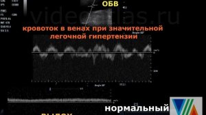 Легочная гипертензия и нарушение кровотока в венах