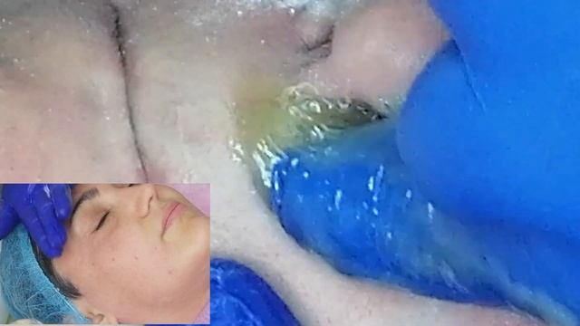 Шугаринг Носа и Лица. Удаление волос сахаром.