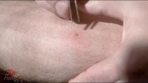 Мелкий КЛЕЩ)) Удаление) "После повреждения"В домашних условиях!!!