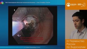 Использование нового способа эндоскопического лечения цилиндроклеточной метаплазии пищевода