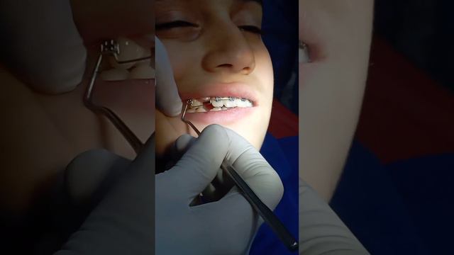 Dr.Telman #breket #azstagram #dentalcare #hekimmesleheti #edit #stomatolog
