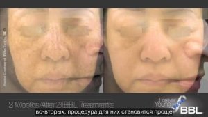 Forever Young BBL Процедура BBL - фотоомоложение