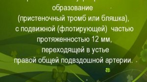 Тромб с флотирующей частью бифуркации аорты как возможный источник тромбоэмболии подколенной артери