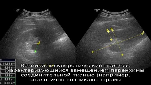 Уплотнение в почке смотреть онлайн