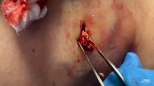 Watch This Giant Cyst SQUIRT! ?